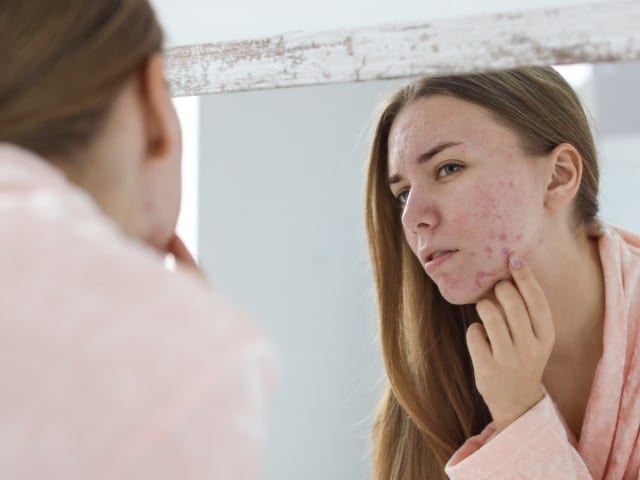 Remedies for Fading Acne Scars